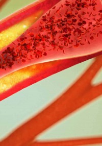 Image of Atherosclerotic cardiovascular disease
