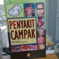 Image of Penyakit campak